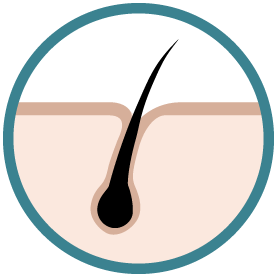 Implants capillaires DHI